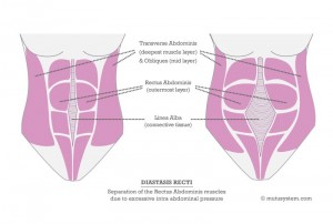 Aurora Clinics; Image showing the separation of Rectus Abdominis Muscles