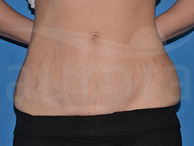 Before-Mini Tummy Tuck