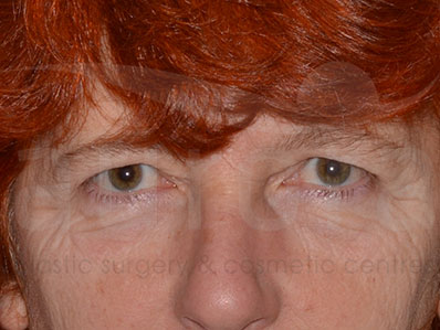 Before-Eyelid Surgery