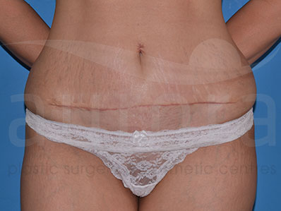 After-Mini Tummy Tuck