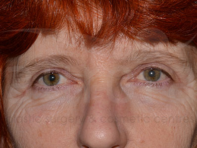 After-Eyelid Surgery