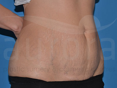 Before-Mini Tummy Tuck