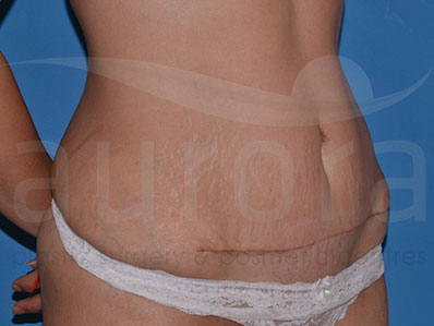 After-Mini Tummy Tuck