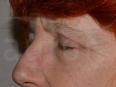 After-Eyelid Surgery