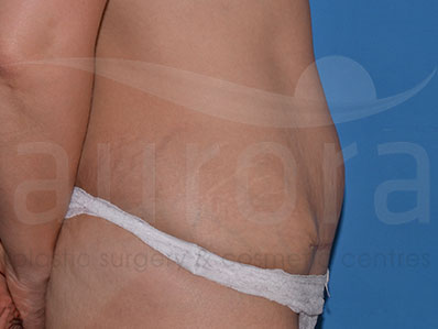 After-Mini Tummy Tuck