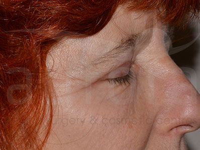 After-Eyelid Surgery