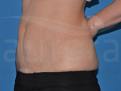 Before-Mini Tummy Tuck