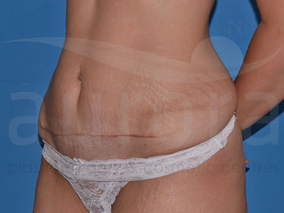 After-Mini Tummy Tuck