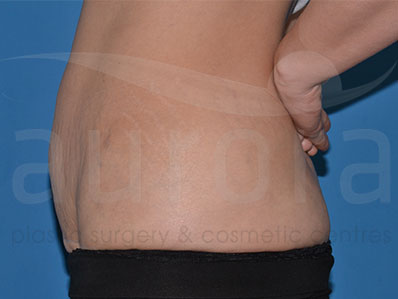 Before-Mini Tummy Tuck