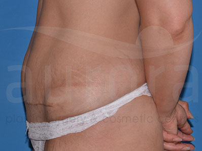 After-Mini Tummy Tuck